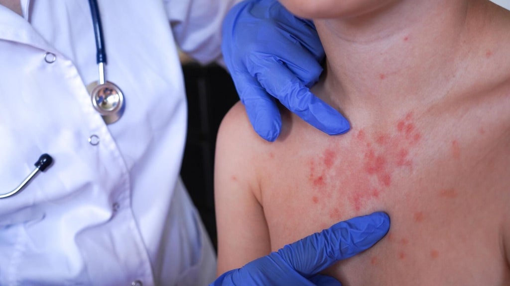 Minnesota's 80 measles cases this year are the most since 1990, health officials say — Savage Health news