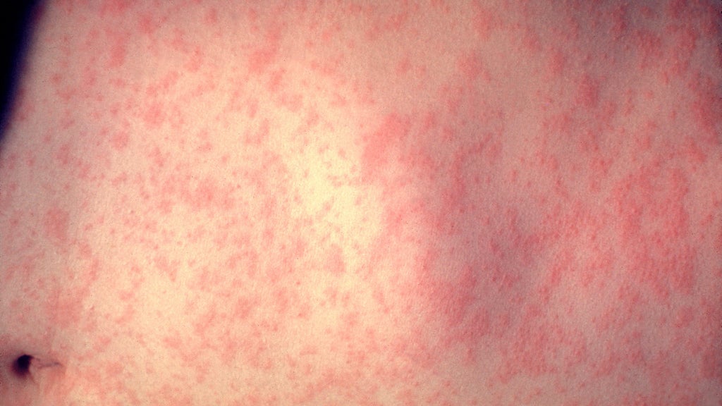25 cases of measles identified in central, southeastern Minnesota, MDH says — WCCO / CBS Minnesota, Savage Health news